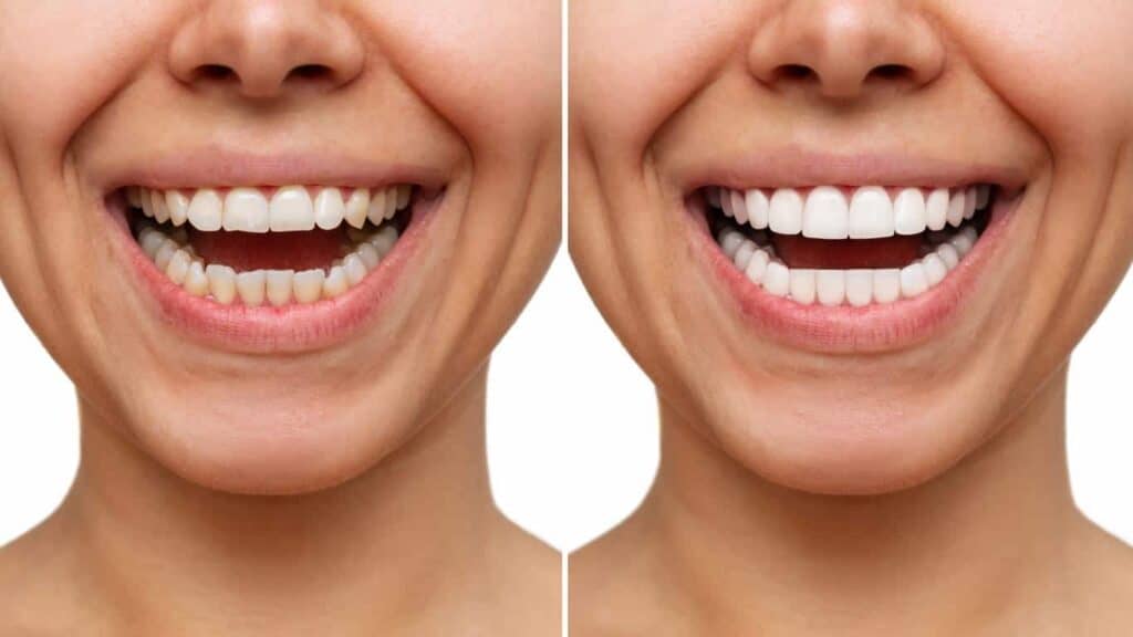 Before and after teeth whitening results. Portsmouth