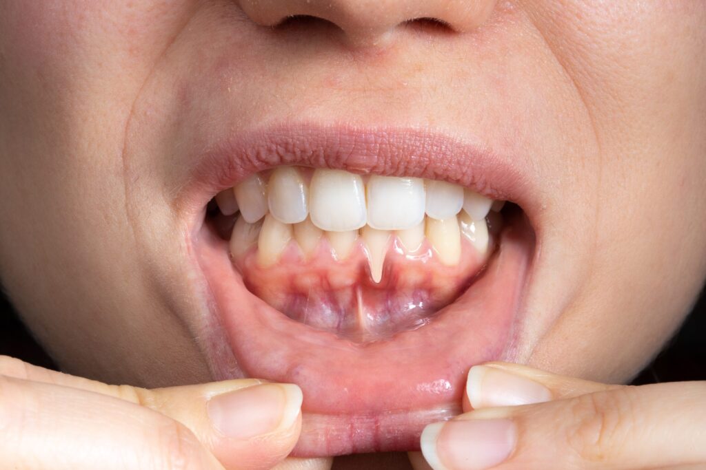 Preparing for teeth whitening with receding gums Portsmouth