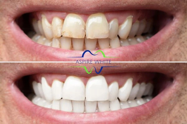 Achieve a radiant smile with professional laser teeth whitening Portsmouth